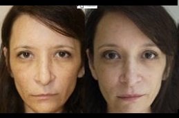 Best Make Over Cosmetic Surgery cost in Riyadh
