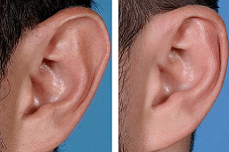 Best Preauricular Tag Removal Treatment clinic in riyadh