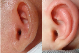 Best Preauricular Tag Removal Treatment cost in Riyadh