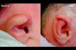 Best Preauricular Tag Removal in riyadh