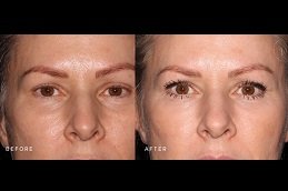 Best Under Eye Fillers surgeons