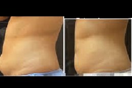 Body Contouring Treatment clinic in riyadh