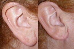 Ear Reshaping cost in riyadh