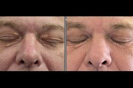 Eyelid Xanthelasma Removal clinic in riyadh