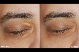 Eyelid Xanthelasma Removal cost in riyadh