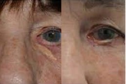 Eyelid Xanthelasma Removal in Riyadh