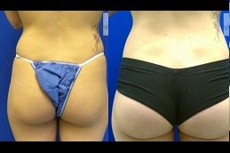 French Butt Reshaping Clinic Riyadh