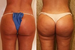 French Butt Reshaping clinic in riyadh