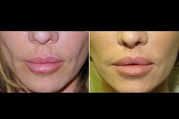 Lip Lift Surgery cost in riyadh