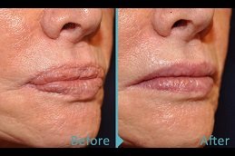 Lip Reduction Surgery clinic in riyadh