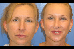 Make Over Cosmetic Surgery cost in riyadh