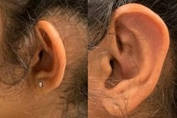 Preauricular Tag Removal Clinic Riyadh