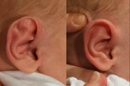 Preauricular Tag Removal cost in riyadh