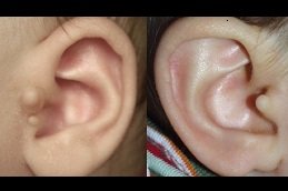 Preauricular Tag Removal in riyadh