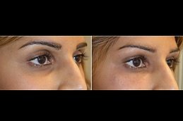 Under Eye Fillers clinic in riyadh