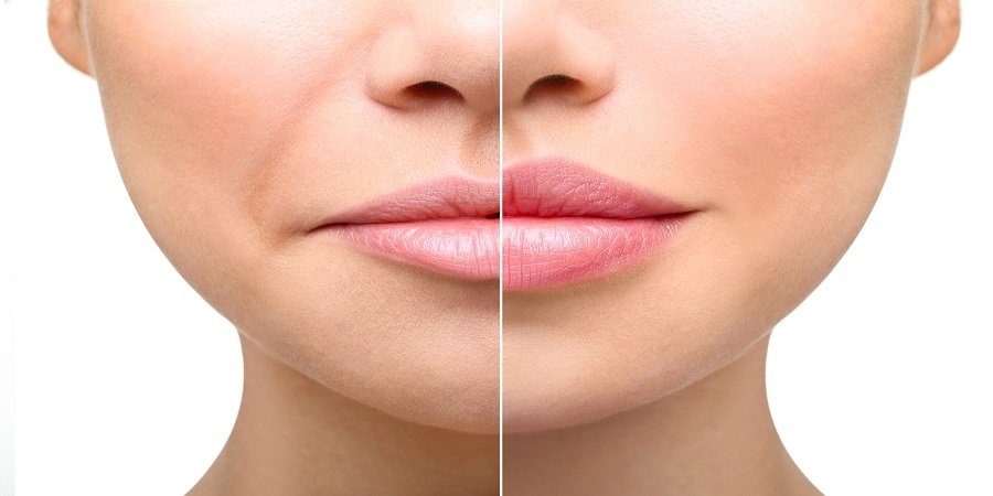 How Much Does 1ml Of Lip Filler Cost in Riyadh