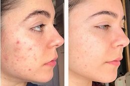 Acne Treatment clinic in riyadh