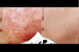 Acne Treatment in Riyadh