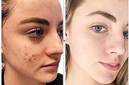 Best Acne Treatment clinic in riyadh