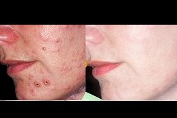 Best Acne Treatment cost in Riyadh