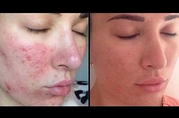 Best Acne Treatment surgeons