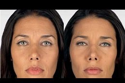 Best Botox Injections For Wrinkles clinic in riyadh