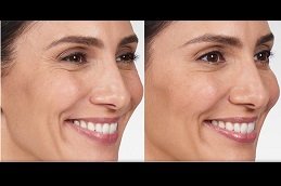 Best Botox Injections For Wrinkles in riyadh