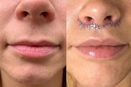 Best Botox Lip Flip clinic in riyadh