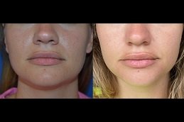 Best Botox Lip Flip cost in Riyadh