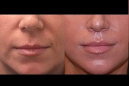 Best Botox Lip Flip in riyadh