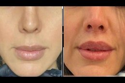 Best Botox Lip Flip surgeons