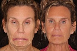 Best Botulinum Toxin Injections cost in Riyadh