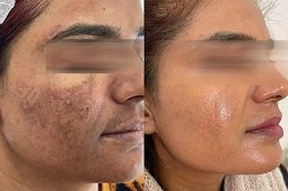 Best Cosmelan Peel cost in Riyadh