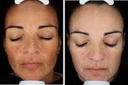 Best Dermamelan Peel cost in Riyadh