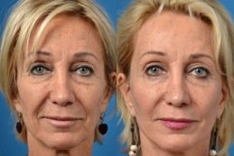 Best Hyaluronic Acid Injections clinic in riyadh