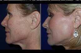 Best J Plasma Skin Resurfacing cost in Riyadh