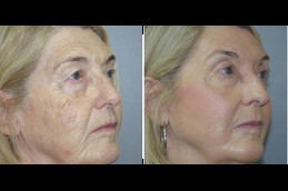 Best J Plasma Skin Resurfacing in riyadh