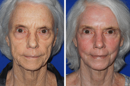 Best J Plasma Skin Resurfacing surgeons