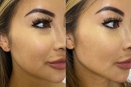 Best Jawline Fillers Injections clinic in riyadh