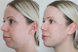 Best Jawline Fillers Injections cost in Riyadh
