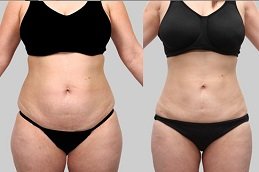 Best Liposuction surgery surgeons