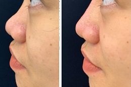 Best Liquid Rhinoplasty clinic in riyadh