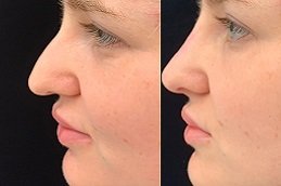 Best Liquid Rhinoplasty cost in Riyadh