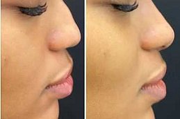 Best Liquid Rhinoplasty surgeons