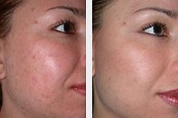 Best Microdermabrasion with Ultrasound clinic in riyadh