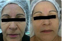 Best Microdermabrasion with Ultrasound surgeons