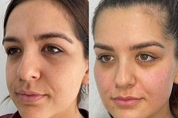 Best Non-Surgical Facelift cost in Riyadh