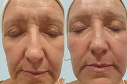 Best Non-Surgical Facelift in riyadh