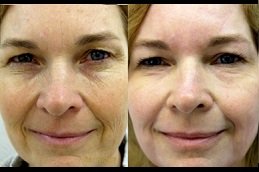 Best Salicylic Acid Peeling clinic in riyadh