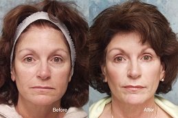 Best Salicylic Acid Peeling surgeons